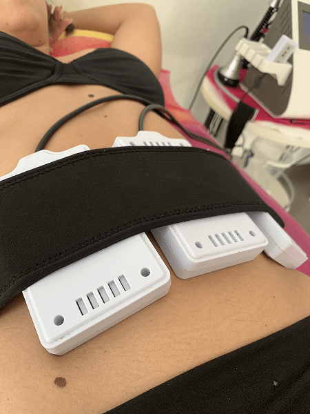 Lipolaser – bezbolno oblikovanje tela pomoću laserske tehnologije